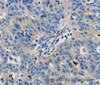 Immunohistochemistry of paraffin-embedded Human ovarian cancer tissue using GRIA3 Polyclonal Antibody at dilution 1:50
