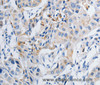 Immunohistochemistry of paraffin-embedded Human lung cancer tissue using GRIA3 Polyclonal Antibody at dilution 1:50
