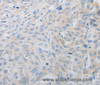 Immunohistochemistry of paraffin-embedded Human esophagus cancer using PDX1 Polyclonal Antibody at dilution of 1:30