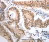 Immunohistochemistry of paraffin-embedded Human colon cancer tissue using RAD52 Polyclonal Antibody at dilution 1:50