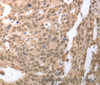 Immunohistochemistry of paraffin-embedded Human ovarian cancer tissue using RAD52 Polyclonal Antibody at dilution 1:50