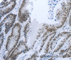 Immunohistochemistry of paraffin-embedded Human colon cancer tissue using RBMS1 Polyclonal Antibody at dilution 1:30