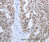 Immunohistochemistry of paraffin-embedded Human ovarian cancer tissue using RBMS1 Polyclonal Antibody at dilution 1:30