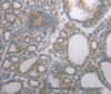 Immunohistochemistry of paraffin-embedded Human thyroid cancer using RBMS3 Polyclonal Antibody at dilution of 1:70