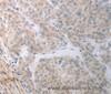 Immunohistochemistry of paraffin-embedded Human liver cancer using RBMS3 Polyclonal Antibody at dilution of 1:70