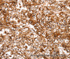 Immunohistochemistry of paraffin-embedded Human renal cancer tissue using SLC9A3R2 Polyclonal Antibody at dilution 1:40