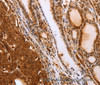 Immunohistochemistry of paraffin-embedded Human thyroid cancer tissue using SLC9A3R2 Polyclonal Antibody at dilution 1:40