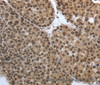 Immunohistochemistry of paraffin-embedded Human liver cancer tissue using SMAD7 Polyclonal Antibody at dilution 1:40