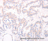 Immunohistochemistry of paraffin-embedded Human thyroid cancer tissue using AMH Polyclonal Antibody at dilution 1:30