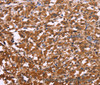 Immunohistochemistry of paraffin-embedded Human thyroid cancer using APMAP Polyclonal Antibody at dilution of 1:30