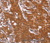 Immunohistochemistry of paraffin-embedded Human gastric cancer using APMAP Polyclonal Antibody at dilution of 1:30