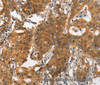 Immunohistochemistry of paraffin-embedded Human gastic cancer using ITGA2 Polyclonal Antibody at dilution of 1:30