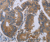 Immunohistochemistry of paraffin-embedded Human colon cancer using PRKD3 Polyclonal Antibody at dilution of 1:50