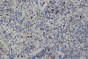 Immunohistochemistry of paraffin-embedded Human cervical cancer tissue using CD68 Polyclonal Antibody at dilution 1:30