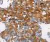 Immunohistochemistry of paraffin-embedded Human cervical cancer tissue using MUC5B Polyclonal Antibody at dilution 1:70