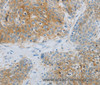 Immunohistochemistry of paraffin-embedded Human esophagus cancer using NDRG1 Polyclonal Antibody at dilution of 1:70