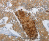 Immunohistochemistry of paraffin-embedded Human breast cancer using NGFR Polyclonal Antibody at dilution of 1:50
