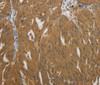Immunohistochemistry of paraffin-embedded Human ovarian cancer using NIT2 Polyclonal Antibody at dilution of 1:40