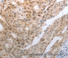 Immunohistochemistry of paraffin-embedded Human esophagus cancer tissue using SLC22A8 Polyclonal Antibody at dilution 1:70