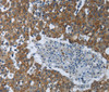 Immunohistochemistry of paraffin-embedded Human breast cancer tissue using EIF2AK2 Polyclonal Antibody at dilution 1:60