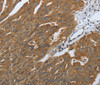 Immunohistochemistry of paraffin-embedded Human ovarian cancer tissue using DLG4 Polyclonal Antibody at dilution 1:40