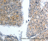 Immunohistochemistry of paraffin-embedded Human liver cancer using Oct-3 Polyclonal Antibody at dilution of 1:40