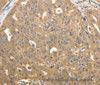 Immunohistochemistry of paraffin-embedded Human ovarian cancer using STX1A Polyclonal Antibody at dilution of 1:40