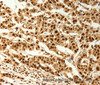 Immunohistochemistry of paraffin-embedded Human cervical cancer  tissue using C12orf5 Polyclonal Antibody at dilution 1:80