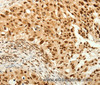 Immunohistochemistry of paraffin-embedded Human breast cancer  tissue using C12orf5 Polyclonal Antibody at dilution 1:80