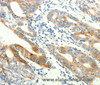 Immunohistochemistry of paraffin-embedded Human gasrtic cancer tissue using TRPA1 Polyclonal Antibody at dilution 1:60