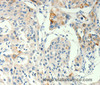 Immunohistochemistry of paraffin-embedded Human lung cancer tissue using TRPA1 Polyclonal Antibody at dilution 1:60