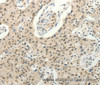 Immunohistochemistry of paraffin-embedded Human lung cancer tissue using Frizzled 10 Polyclonal Antibody at dilution 1:50