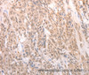 Immunohistochemistry of paraffin-embedded Human liver cancer tissue using ACIN1 Polyclonal Antibody at dilution 1:80