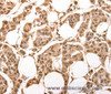 Immunohistochemistry of paraffin-embedded Human breast cancer using ACO2 Polyclonal Antibody at dilution of 1:30