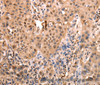 Immunohistochemistry of paraffin-embedded Human lung cancer using ACO2 Polyclonal Antibody at dilution of 1:30