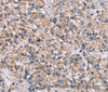 Immunohistochemistry of paraffin-embedded Human prostate cancer tissue using ADAM12 Polyclonal Antibody at dilution 1:40