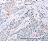 Immunohistochemistry of paraffin-embedded Human breast cancer tissue using AKT2 Polyclonal Antibody at dilution 1:70