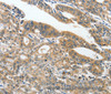 Immunohistochemistry of paraffin-embedded Human gasrtic cancer tissue using ANKZF1 Polyclonal Antibody at dilution 1:40