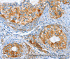 Immunohistochemistry of paraffin-embedded Human cervical cancer tissue using AIP Polyclonal Antibody at dilution 1:80