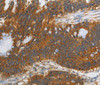 Immunohistochemistry of paraffin-embedded Human colon cancer tissue using PI 3 Kinase Class 3 Polyclonal Antibody at dilution 1:40