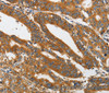 Immunohistochemistry of paraffin-embedded Human gastric cancer tissue using PI 3 Kinase Class 3 Polyclonal Antibody at dilution 1:40