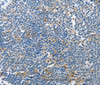 Immunohistochemistry of paraffin-embedded Human lymphoma using PI 3 kinase p85 beta Polyclonal Antibody at dilution of 1:70