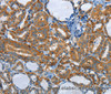 Immunohistochemistry of paraffin-embedded Human thyroid cancer tissue using PIK3R4 Polyclonal Antibody at dilution 1:85