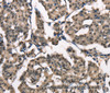 Immunohistochemistry of paraffin-embedded Human breast cancer using NSMCE3 Polyclonal Antibody at dilution of 1:40