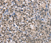 Immunohistochemistry of paraffin-embedded Human esophagus cancer using NSMCE3 Polyclonal Antibody at dilution of 1:40
