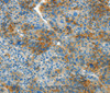 Immunohistochemistry of paraffin-embedded Human liver cancer tissue using L1CAM Polyclonal Antibody at dilution 1:40