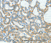 Immunohistochemistry of paraffin-embedded Human thyroid cancer tissue using L1CAM Polyclonal Antibody at dilution 1:40