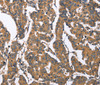 Immunohistochemistry of paraffin-embedded Human breast cancer tissue using BNIP2 Polyclonal Antibody at dilution 1:50