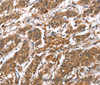 Immunohistochemistry of paraffin-embedded Human gastric cancer tissue using BNIP2 Polyclonal Antibody at dilution 1:50