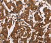 Immunohistochemistry of paraffin-embedded Human breast cancer tissue using ATRN Polyclonal Antibody at dilution 1:50